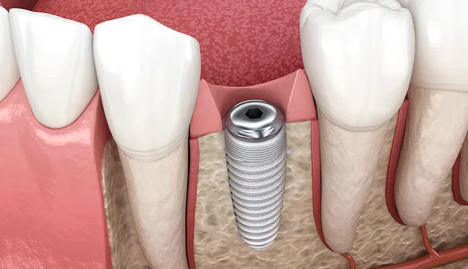 インプラント埋入