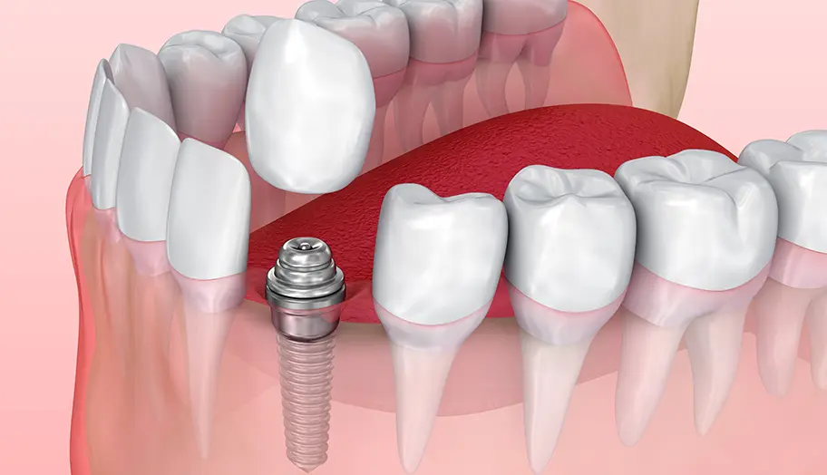 上部構造（人工歯）の装着