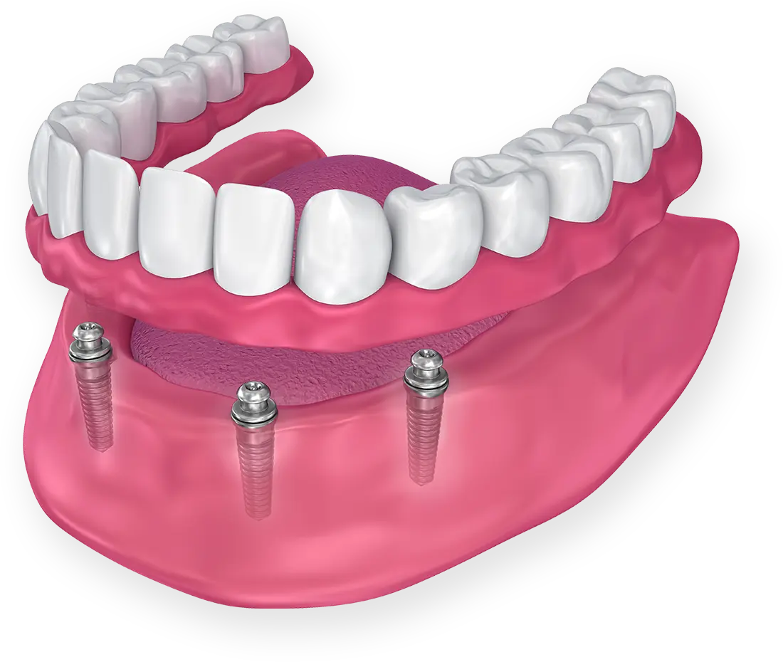 インプラントオーバーデンチャー