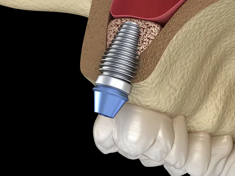 サイナスリフト