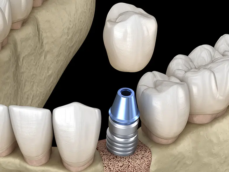 ソケットリフト